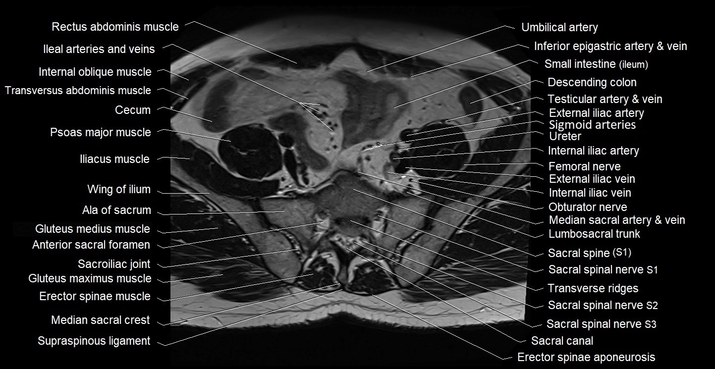 Male pelvis axial cross sectional anatomy image 2.webp